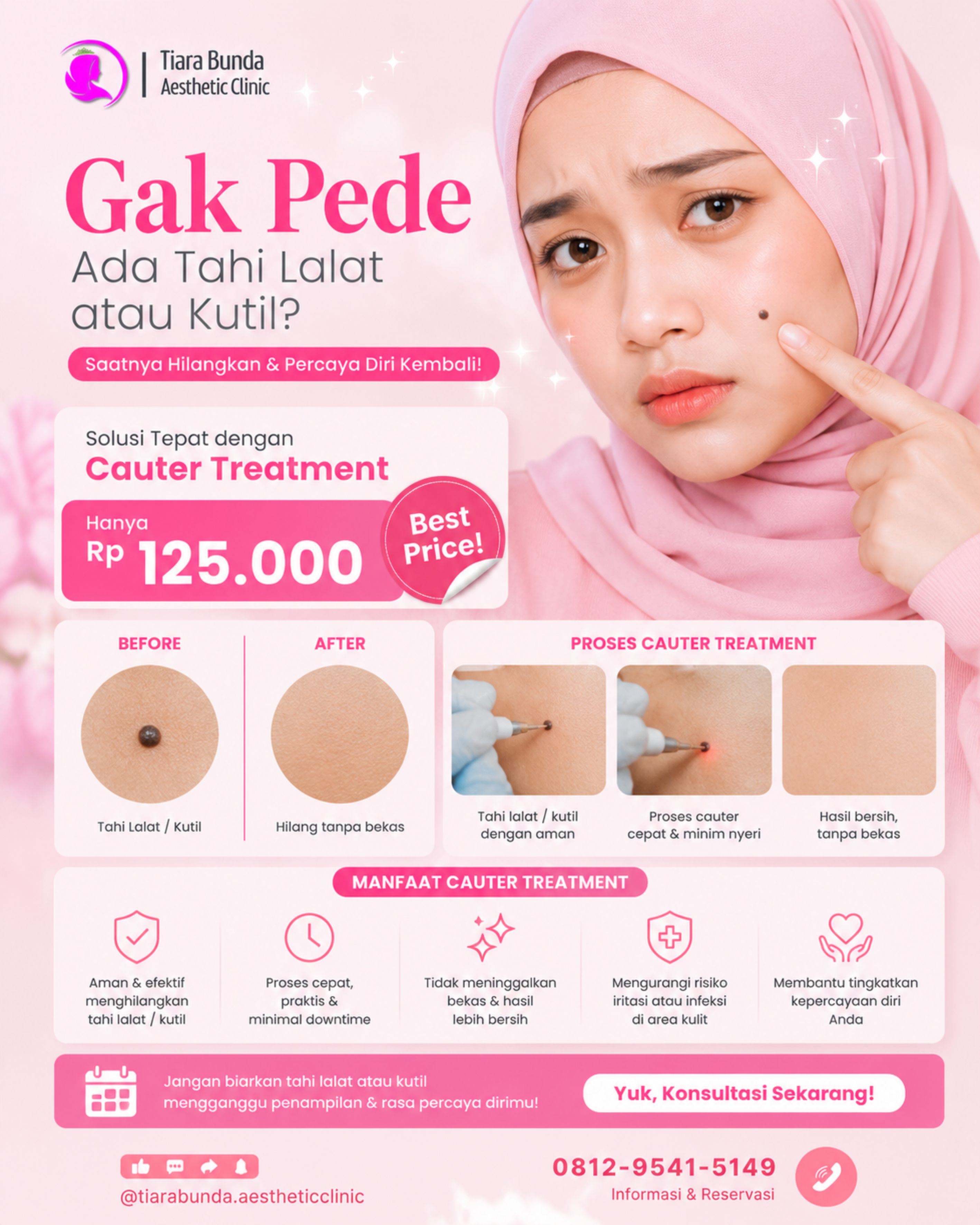 Cauter Tahi Lalat Treatment
